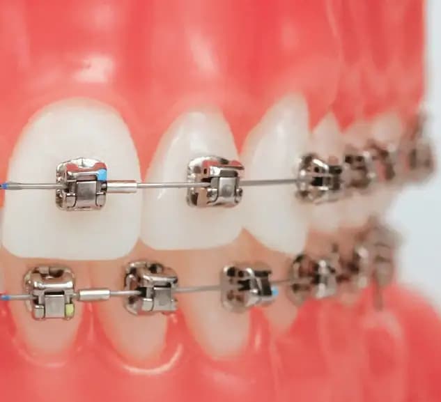 Damon Braces System for Orthodontic Treatment Damon Braces System for Orthodontic Treatment