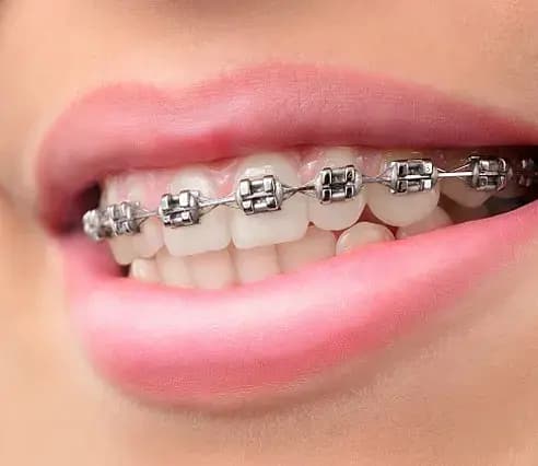 Orthodontist doctor performing treatment with metal braces Orthodontist doctor performing treatment with metal braces